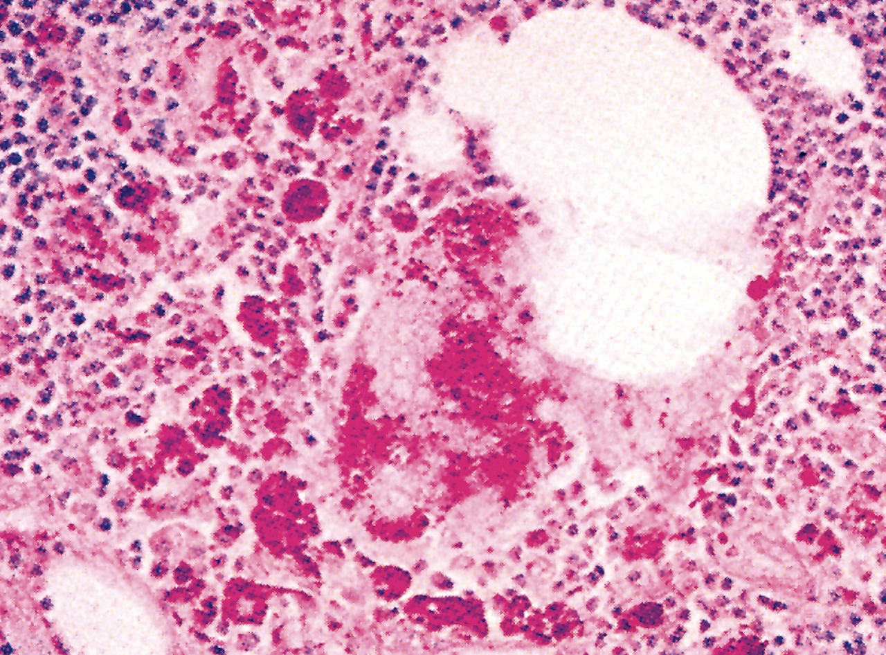 Disease Diagnosis Whipple Disease Diagnosis